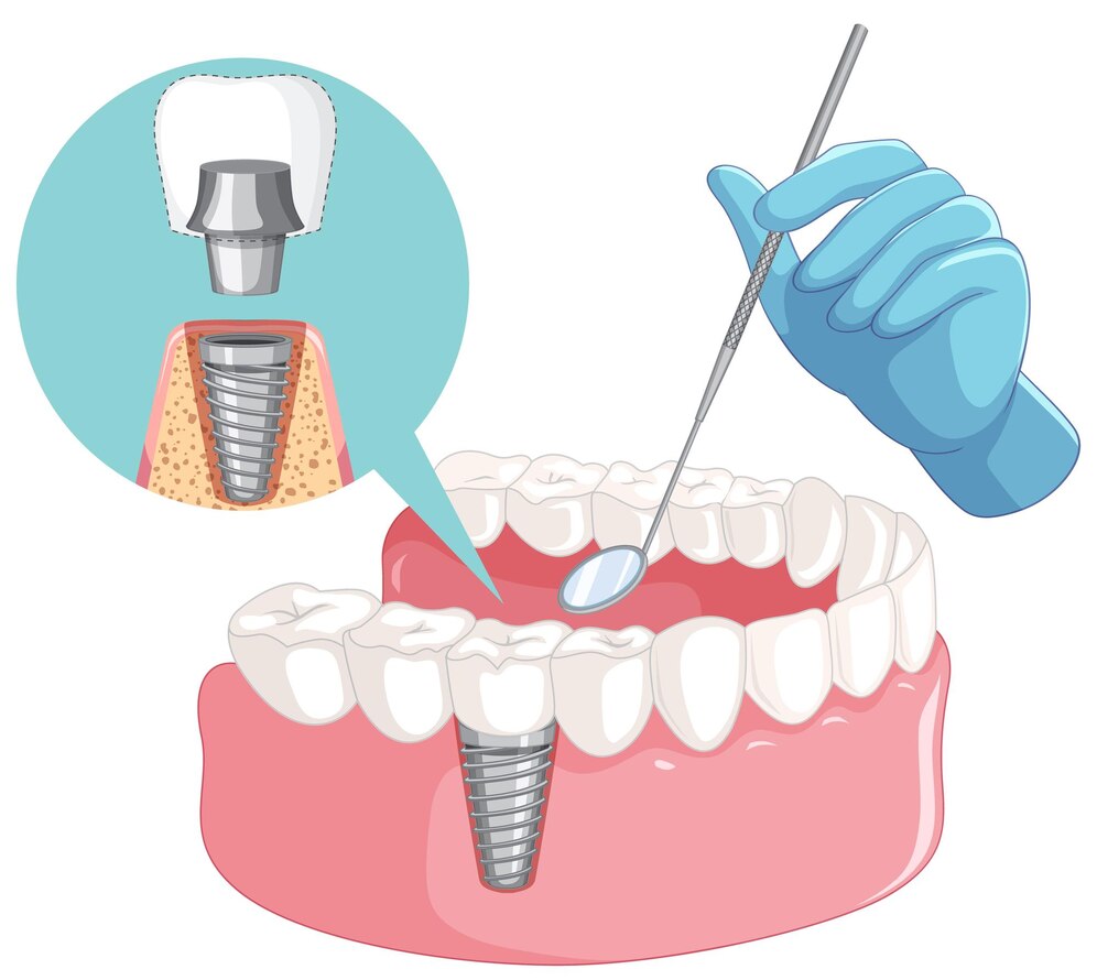 Dental Implant treatment in Laurel, MD