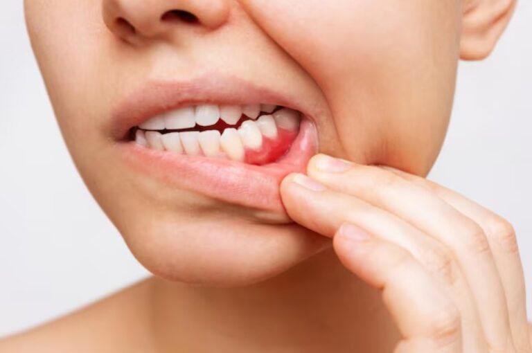 gum disease in Laurel
