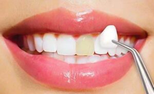 Cosmetic Dentistry in Laurel MD