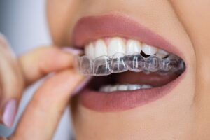 Invisalign in Laurel MD