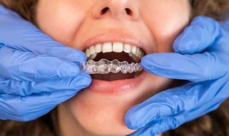 Invisalign in Laurel, MD