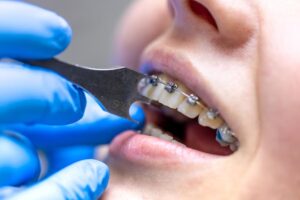 Orthodontics in Laurel MD