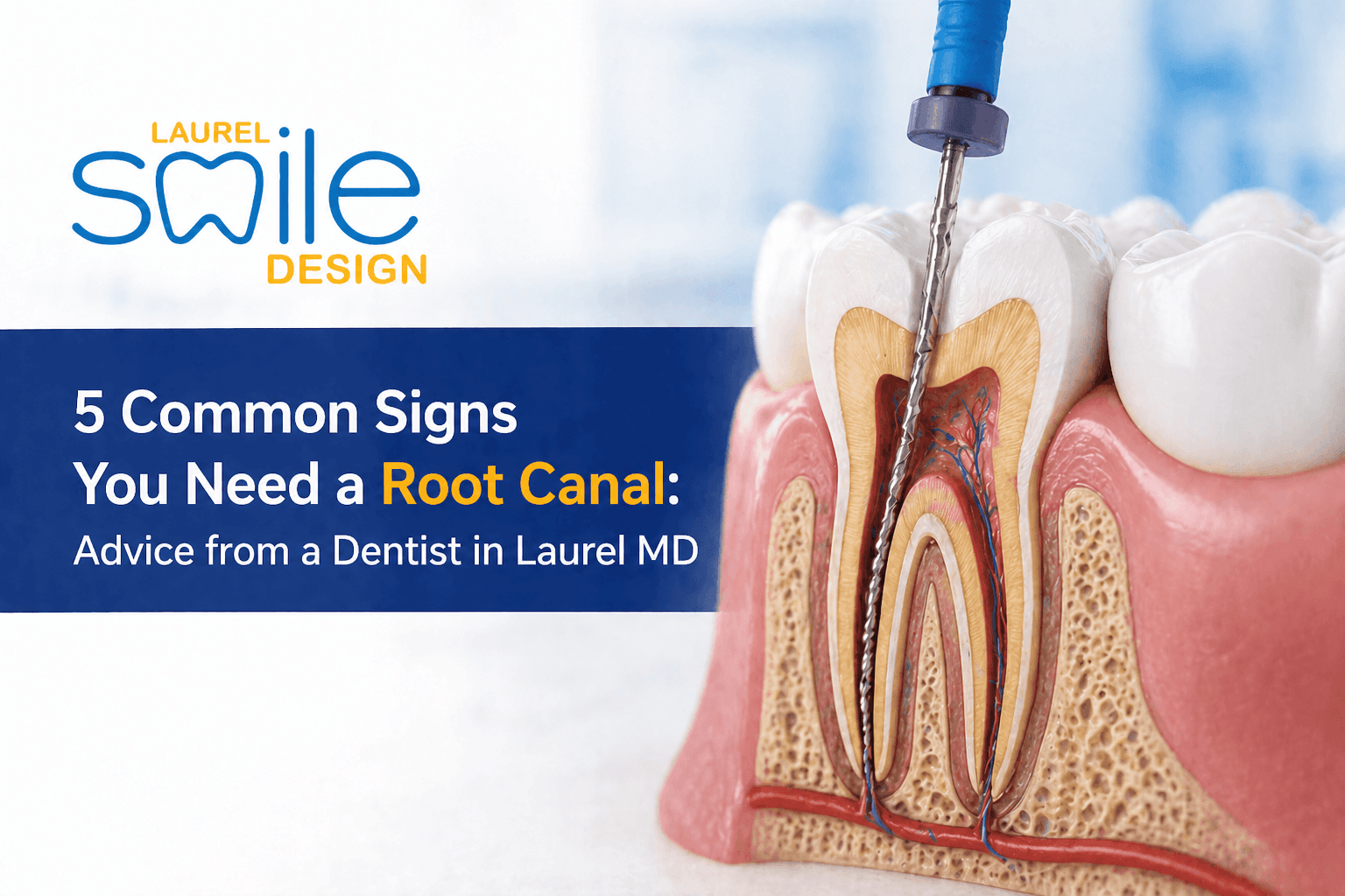 5 Common Signs You Need a Root Canal: Advice from a Dentist in Laurel MD