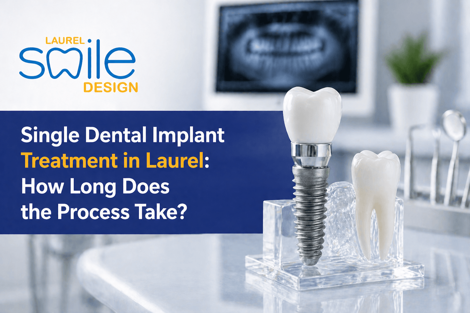 Single Dental Implant Treatment in Laurel: How Long Does the Process Take?