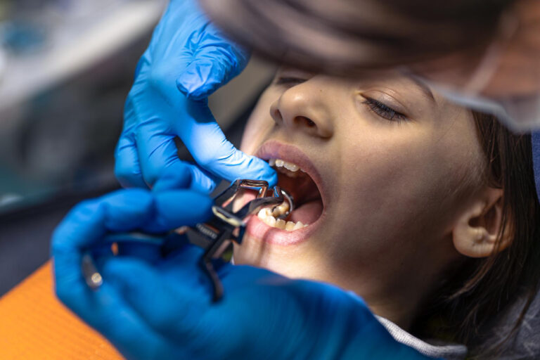Wisdom Tooth Removal Laurel MD