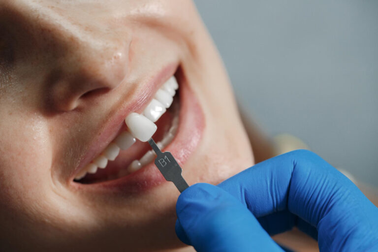 Porcelain Dental Veneers in laurel md