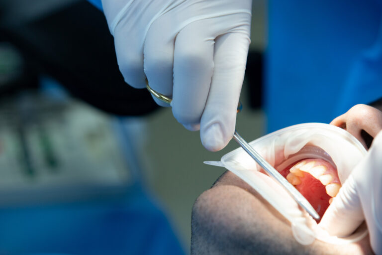 Tooth Replacement in laurel md